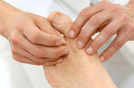 Fuß Akupunktur